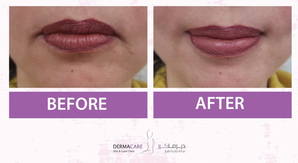 Filler Treatment