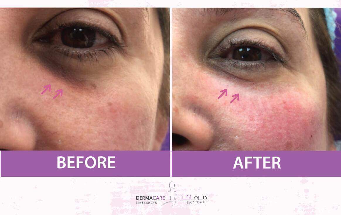 Filler Treatment