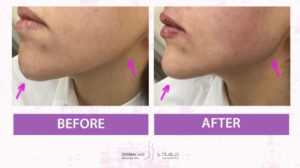 Chin and Jawline Treatement