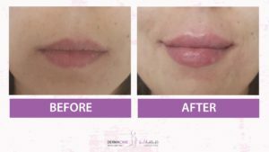 Filler Treatment