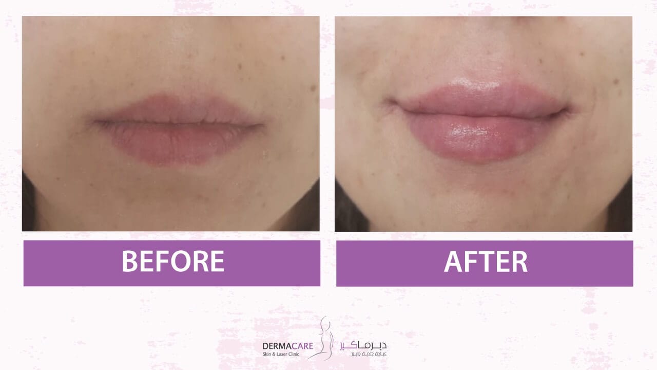Filler Treatment