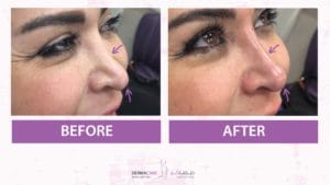 Filler Treatment