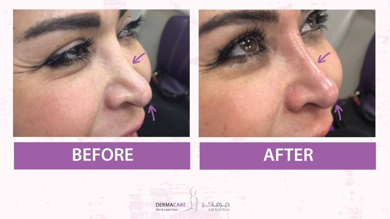Filler Treatment