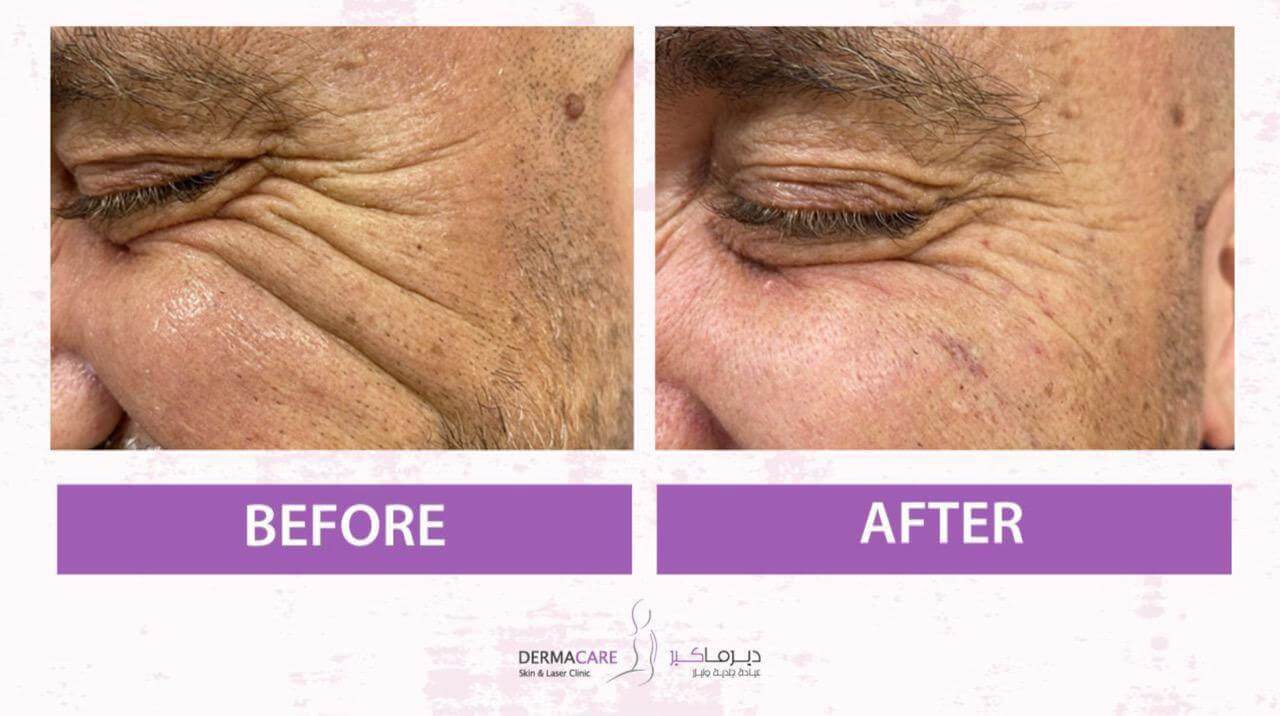 Filler Treatment