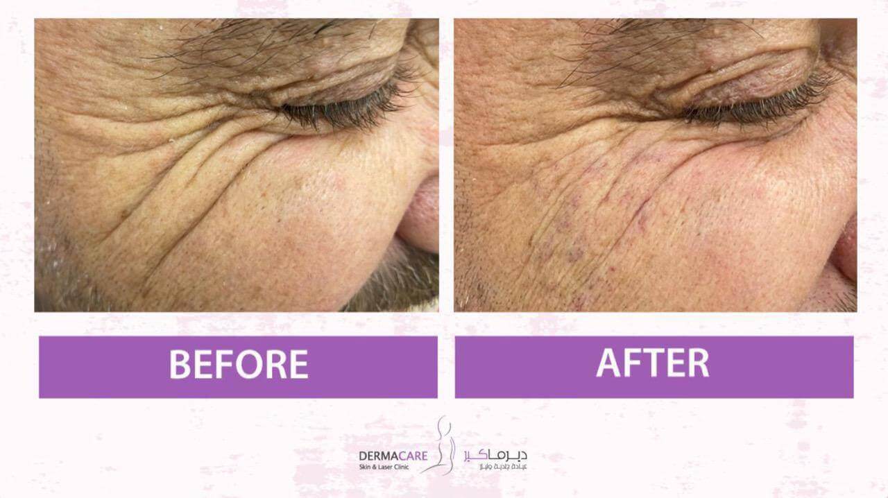 Filler Treatment