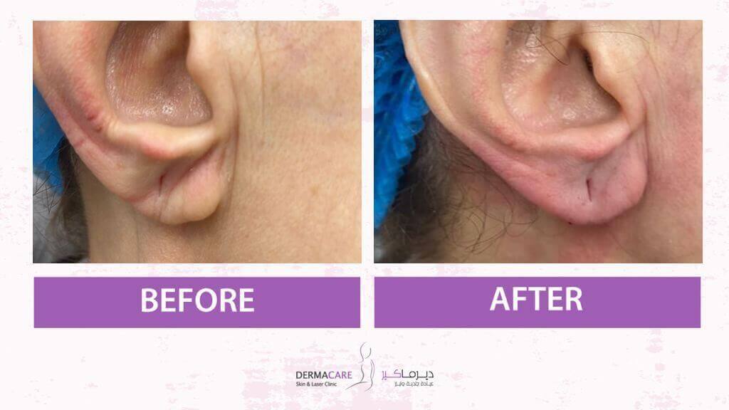 Filler Treatment