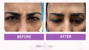 Botox Treatement