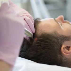 علاج الثعلبة